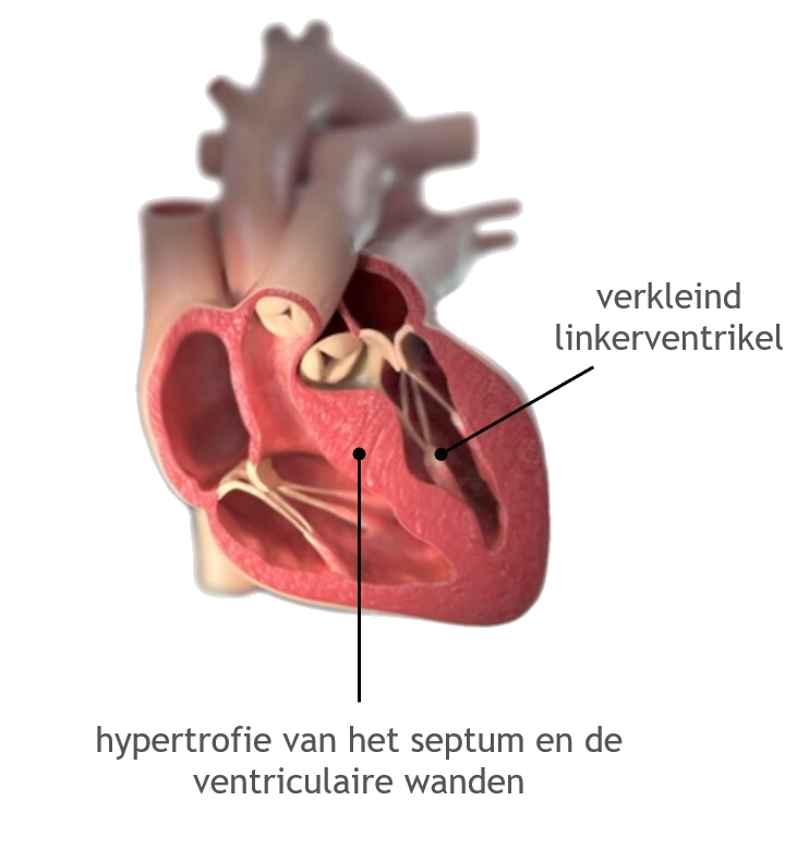 HCM - hypertrofie en verkleind linkerventrikel