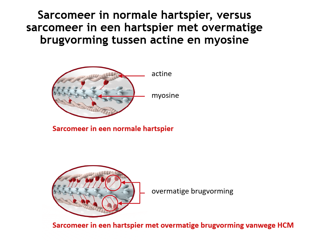 eer met overmatige brugvorming actine myosine.png