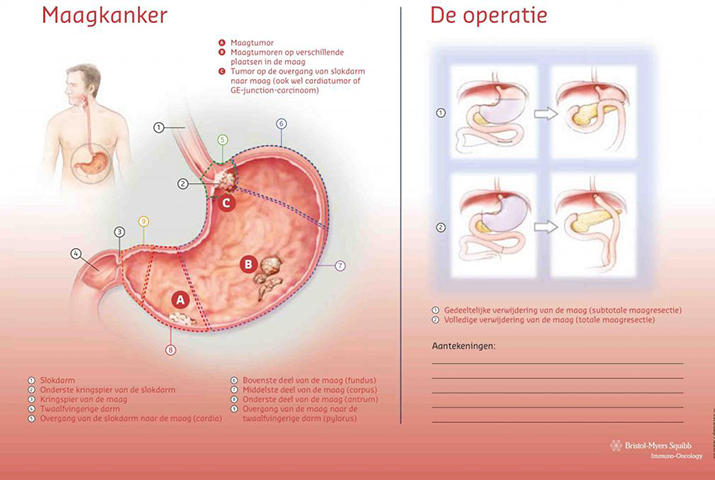 Scheurblok maagkanker.png