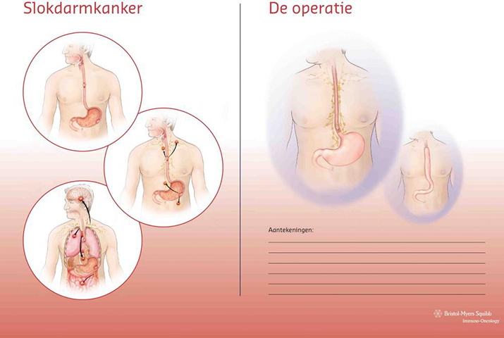 Scheurblok slokdarmkanker.png