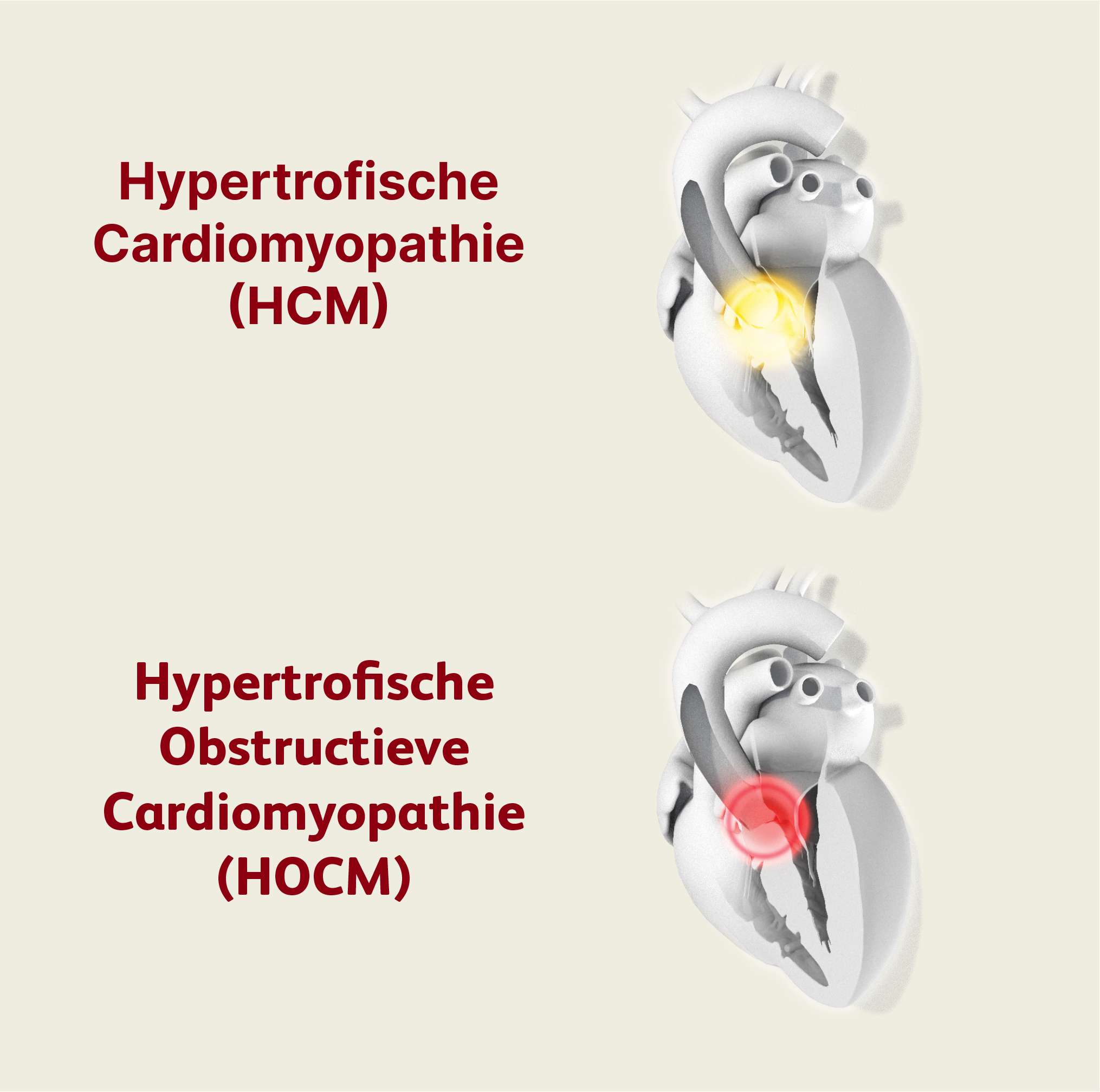 HCM vs HOCM.png