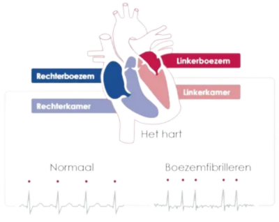 boezemfibrilleren (1).png